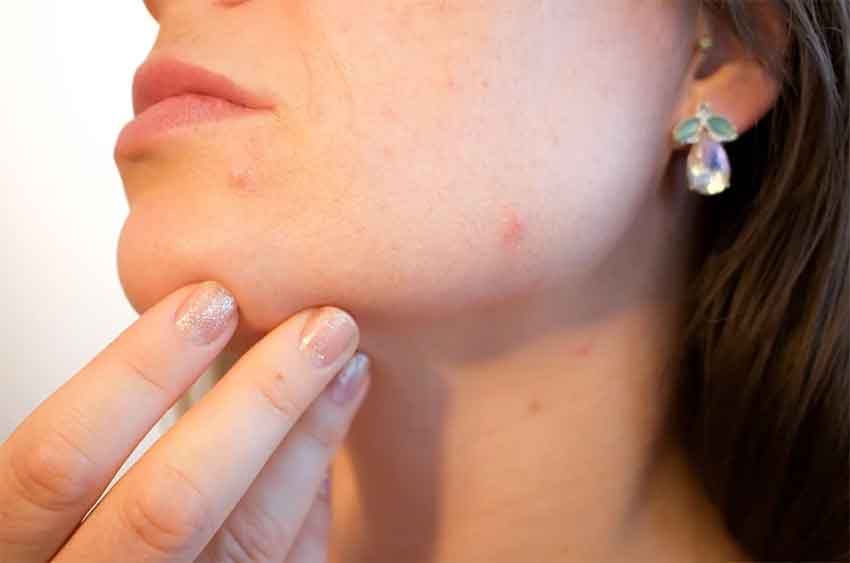 combatir los efectos de la mascarilla sobre la piel acné